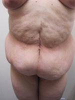 Circumferential Body Lift/ Belt Lipectomy Before & After
