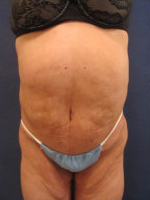 Circumferential Body Lift/ Belt Lipectomy Before & After