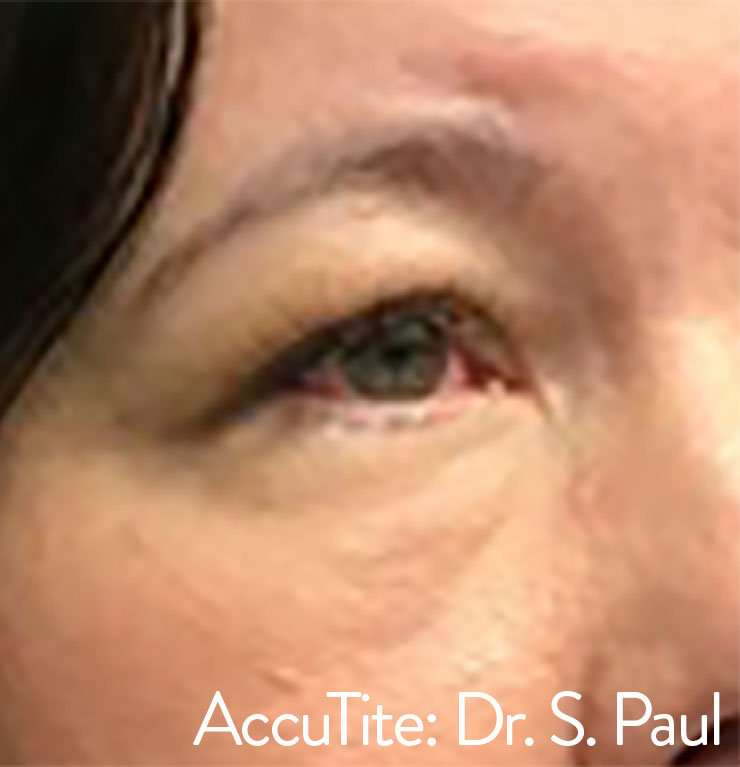 AccuTite Before & After