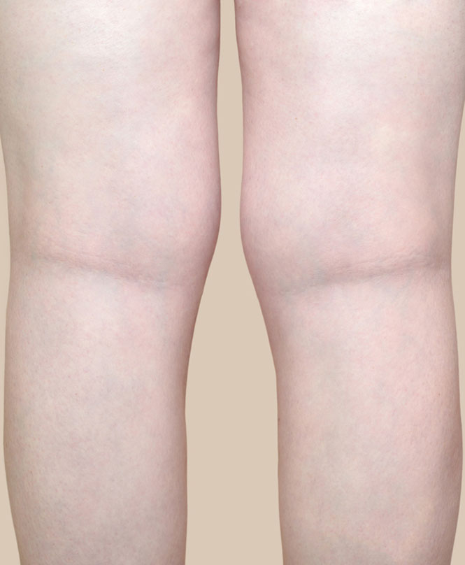 Varicose Vein Before & After