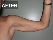 Arm Lift Before & After