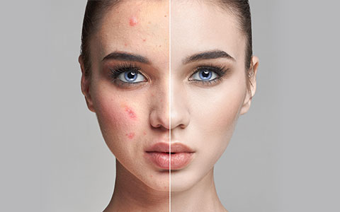 Acne Treatment Before & After